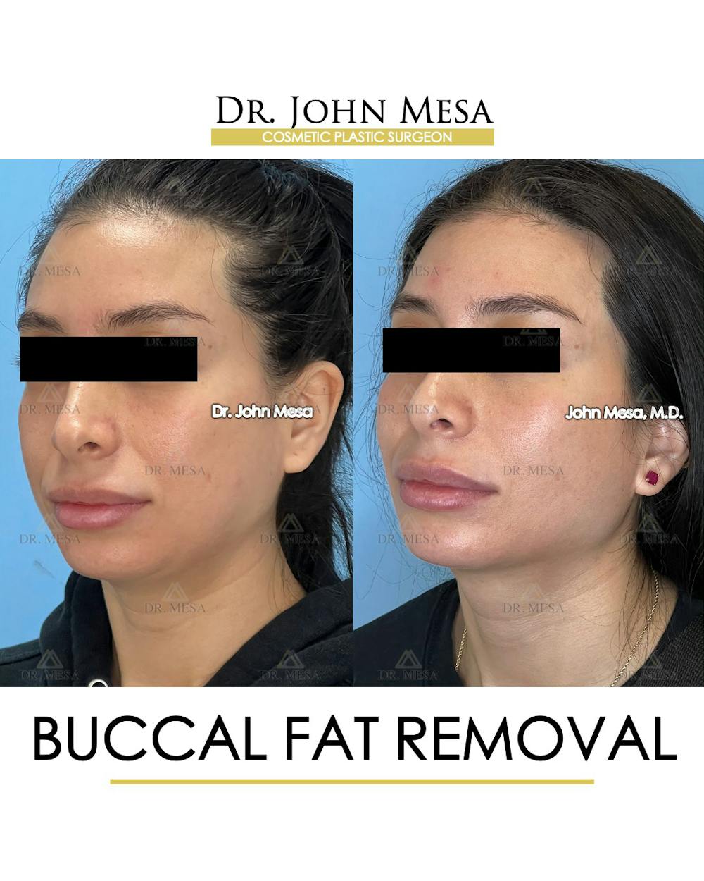 Buccal Fat Pad Removal Before & After Gallery - Patient 148733444 - Image 5