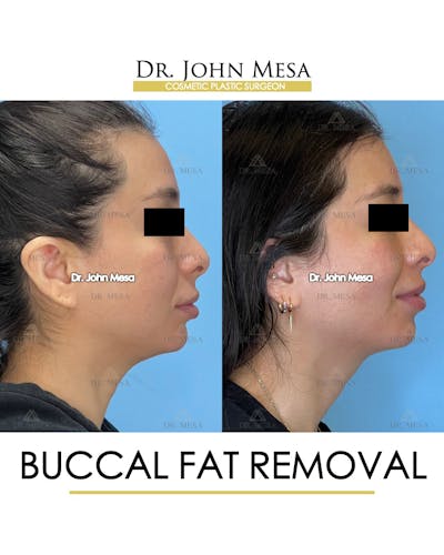 Buccal Fat Pad Removal Before & After Gallery - Patient 148733444 - Image 4