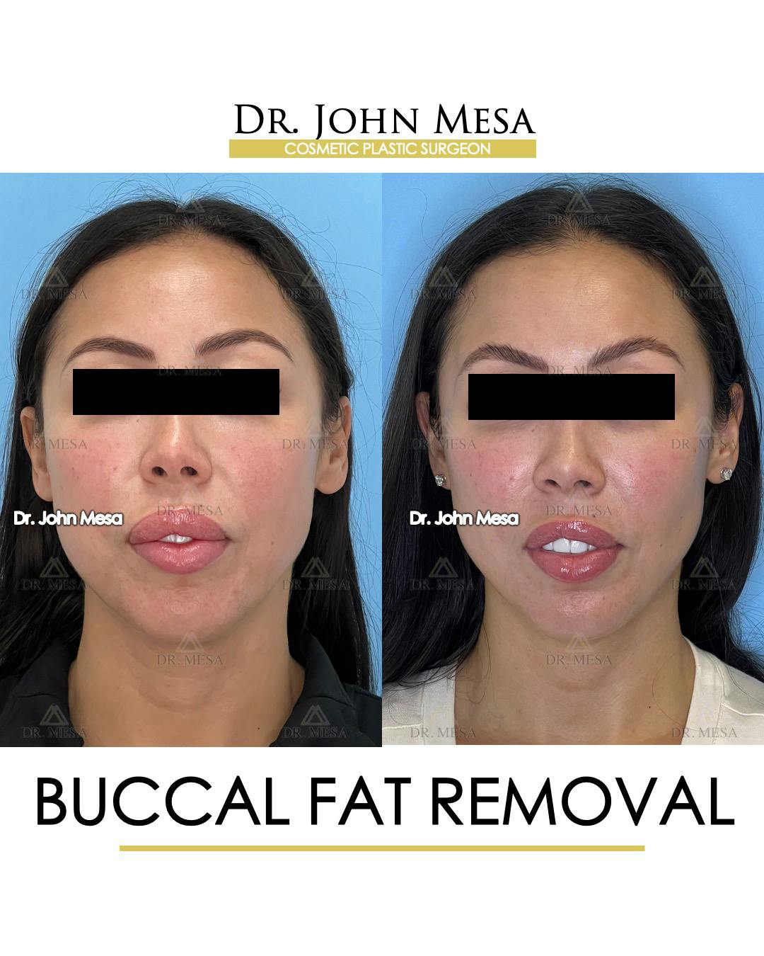 Buccal Fat Pad Removal Before & After Gallery - Patient 148733443 - Image 1
