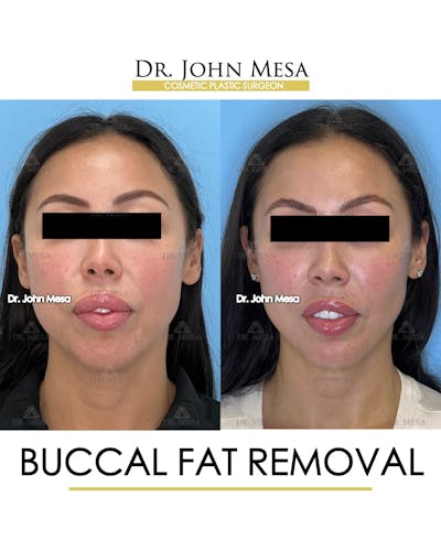 Buccal Fat Pad Removal Before & After Gallery - Patient 148733443 - Image 1