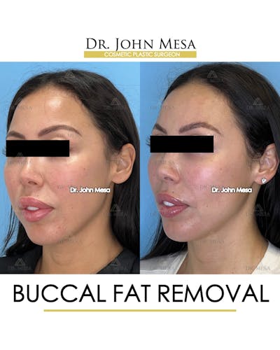 Buccal Fat Pad Removal Before & After Gallery - Patient 148733443 - Image 4