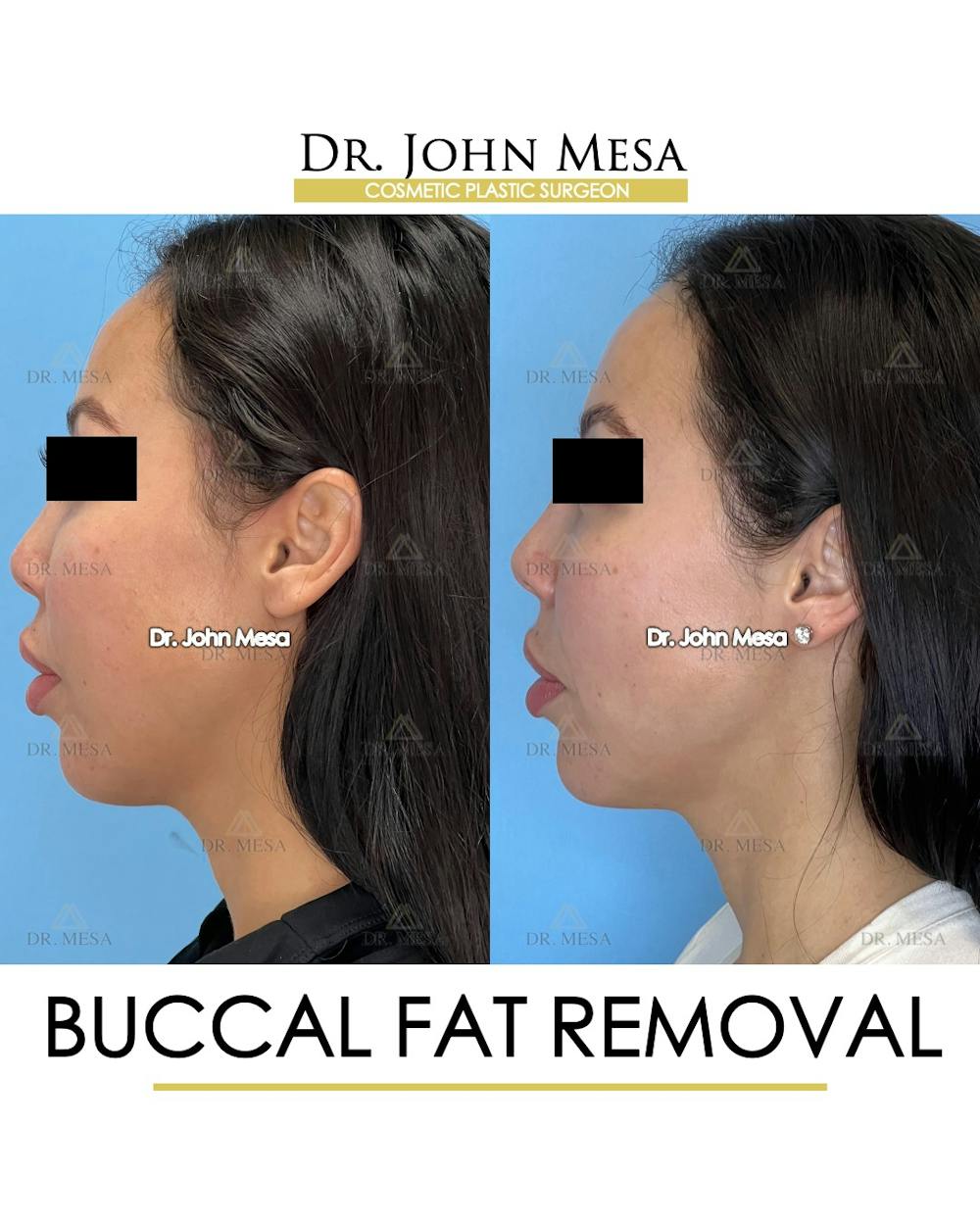 Buccal Fat Pad Removal Before & After Gallery - Patient 148733443 - Image 5