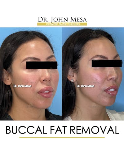 Buccal Fat Pad Removal Before & After Gallery - Patient 148733443 - Image 2