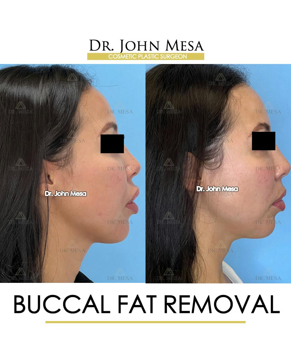 Buccal Fat Pad Removal Before & After Gallery - Patient 148733443 - Image 3