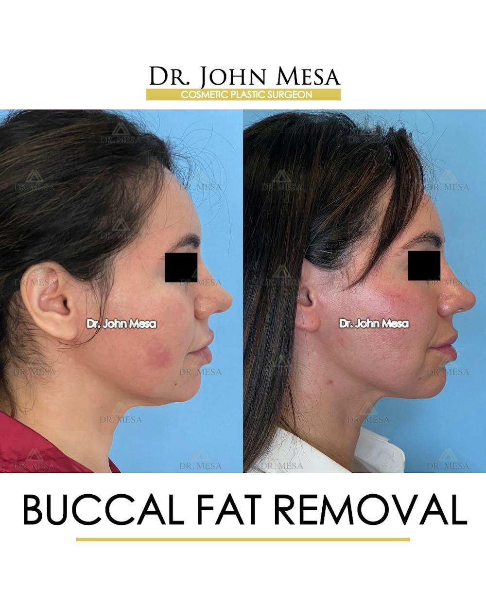 Buccal Fat Pad Removal Before & After Gallery - Patient 148733447 - Image 4