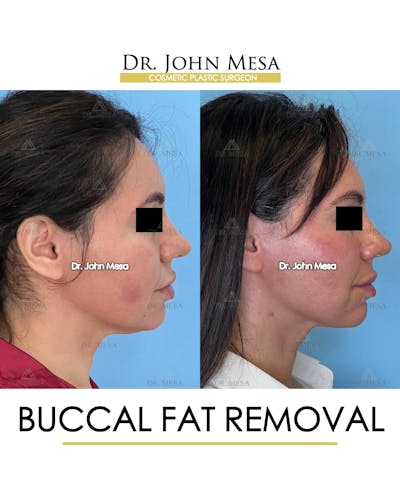 Buccal Fat Pad Removal Before & After Gallery - Patient 148733447 - Image 4