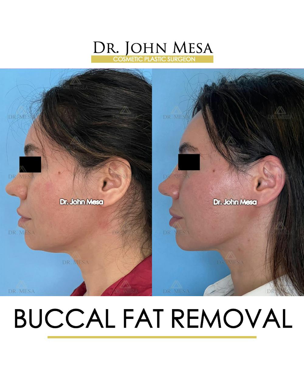 Buccal Fat Pad Removal Before & After Gallery - Patient 148733447 - Image 5