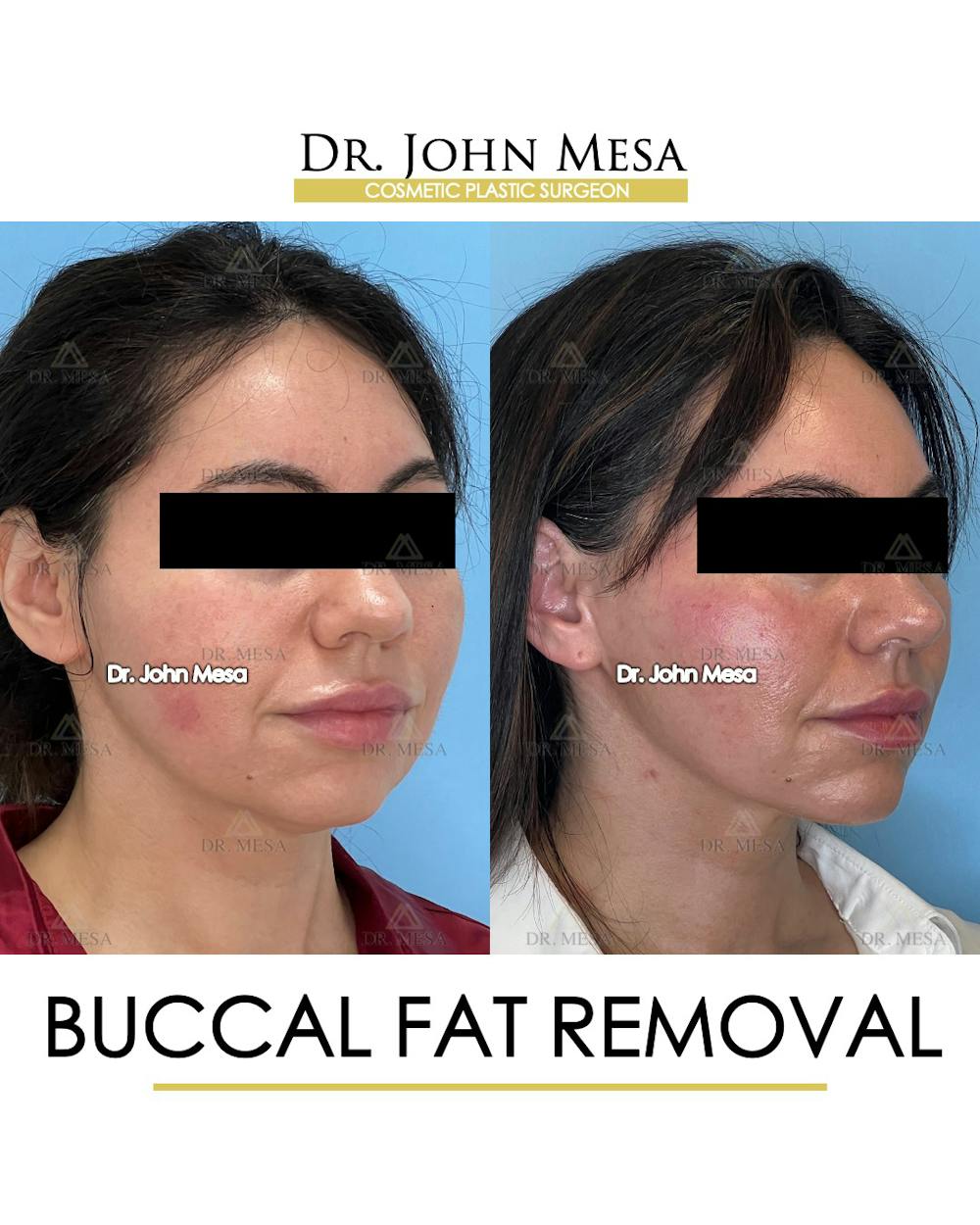 Buccal Fat Pad Removal Before & After Gallery - Patient 148733447 - Image 2