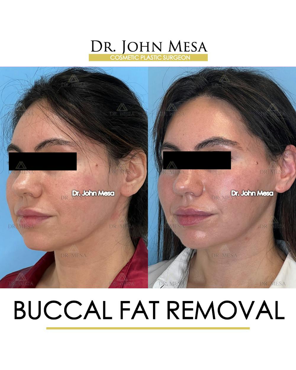 Buccal Fat Pad Removal Before & After Gallery - Patient 148733447 - Image 3