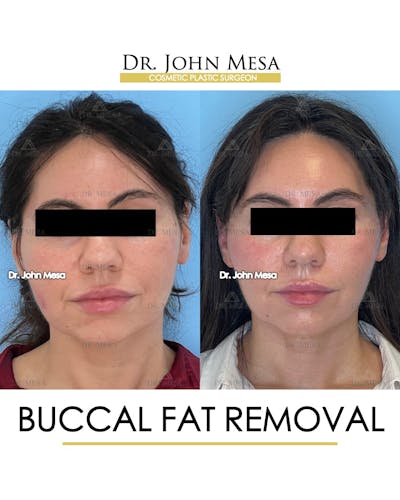 Buccal Fat Pad Removal Before & After Gallery - Patient 148733447 - Image 1