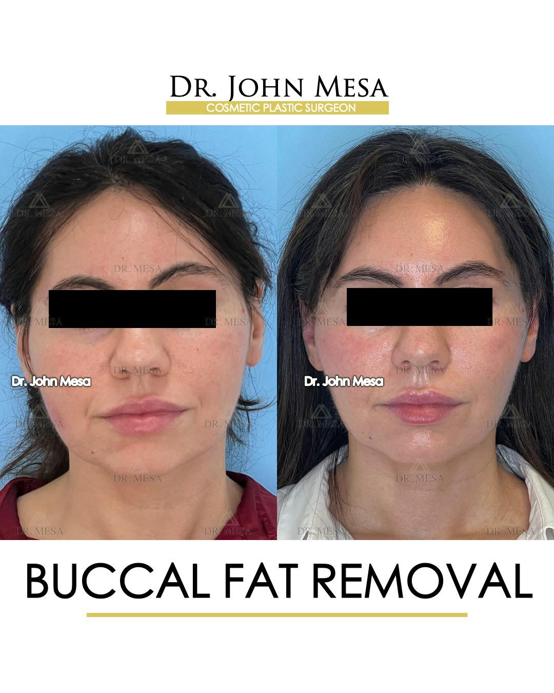 Buccal Fat Pad Removal Before & After Gallery - Patient 148733447 - Image 1