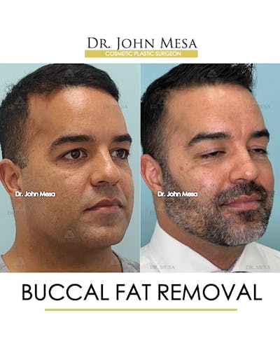 Buccal Fat Pad Removal for Men Before & After Gallery - Patient 148733548 - Image 2