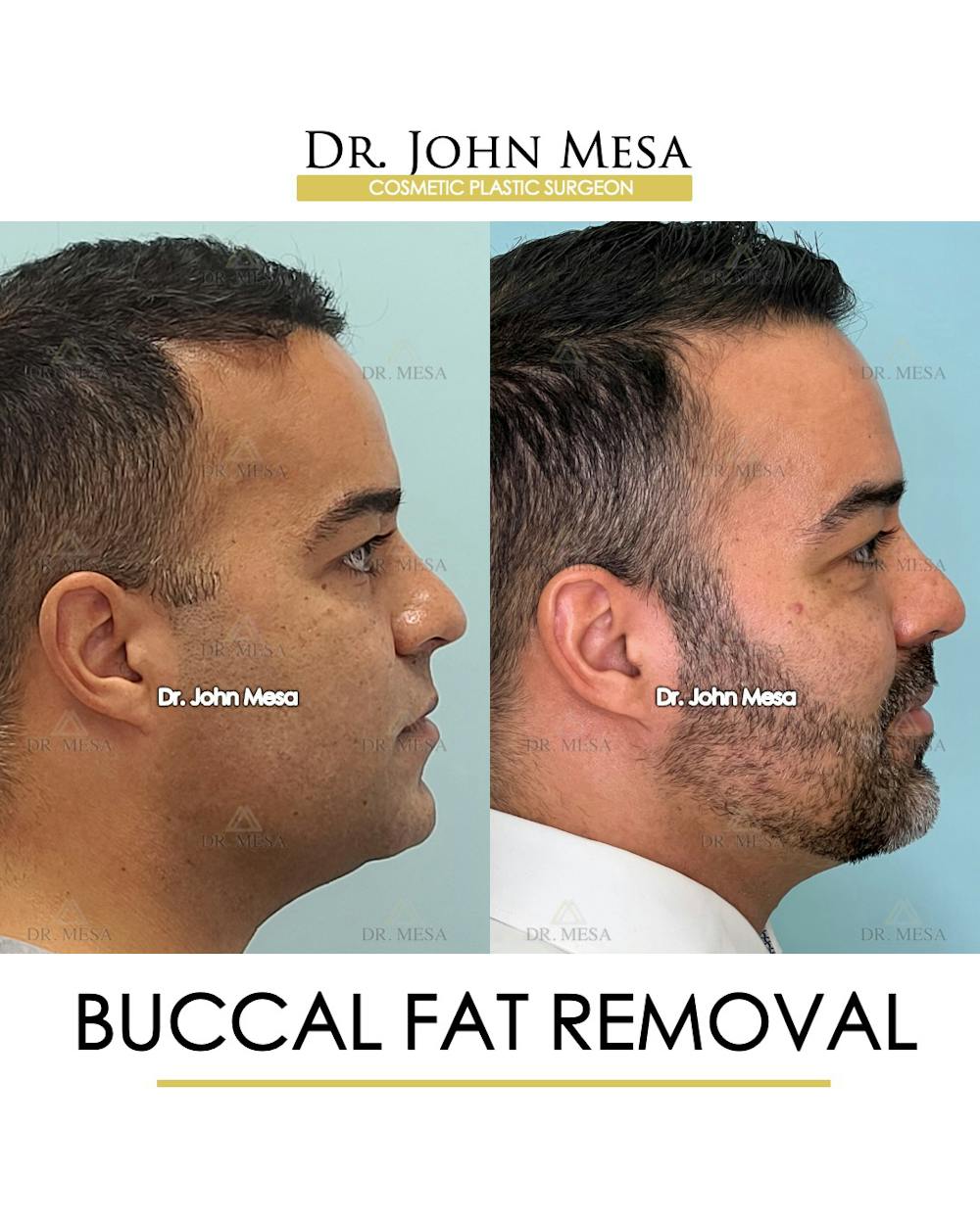 Buccal Fat Pad Removal for Men Before & After Gallery - Patient 148733548 - Image 3