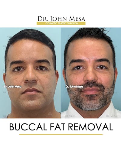 Buccal Fat Pad Removal for Men Before & After Gallery - Patient 148733548 - Image 1