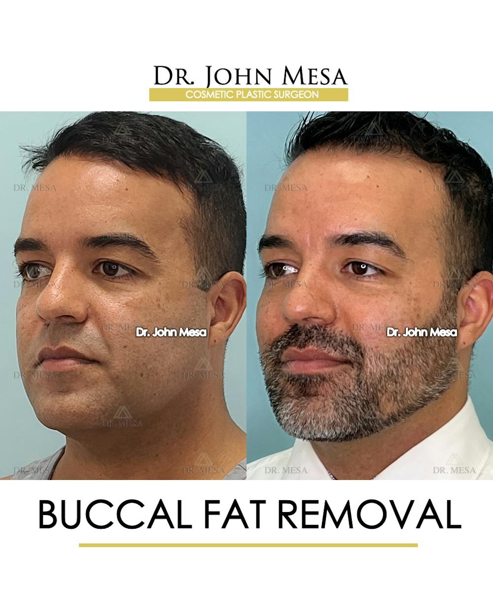 Buccal Fat Pad Removal for Men Before & After Gallery - Patient 148733548 - Image 4