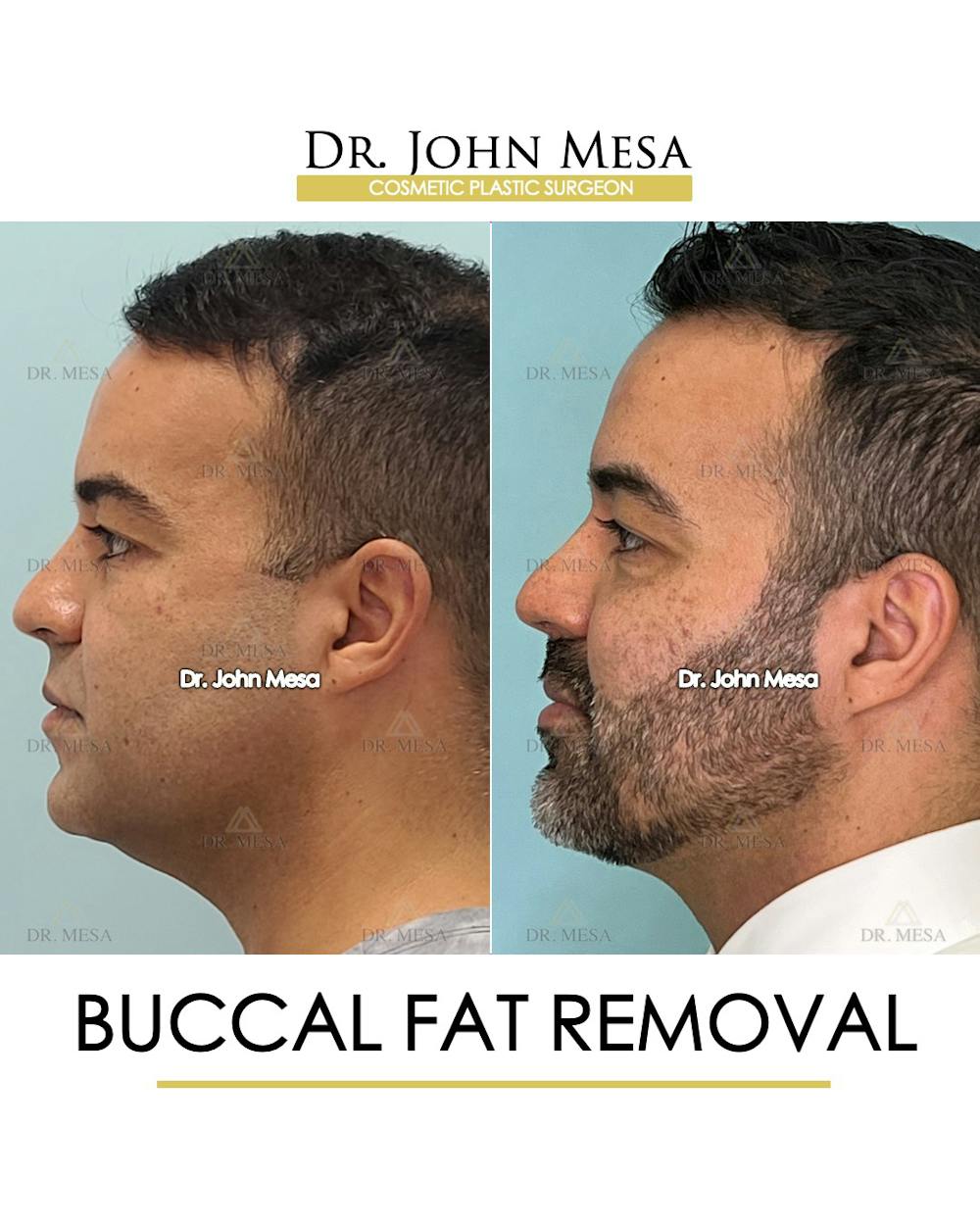 Buccal Fat Pad Removal for Men Before & After Gallery - Patient 148733548 - Image 5