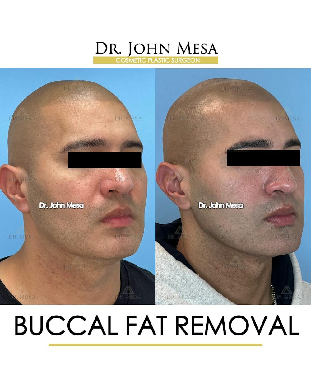Buccal Fat Pad Removal for Men Before & After Gallery - Patient 148733547 - Image 2