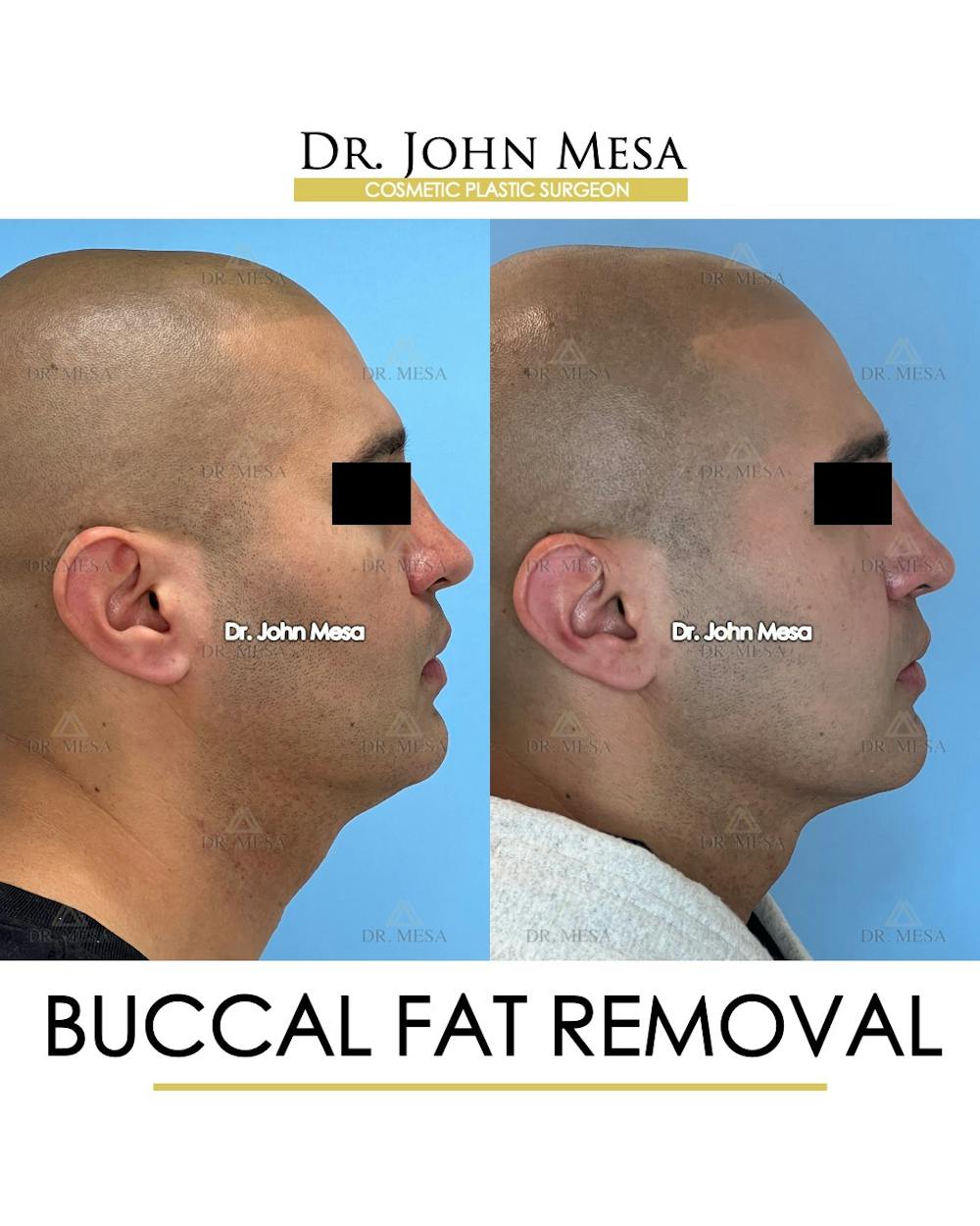 Buccal Fat Pad Removal for Men Before & After Gallery - Patient 148733547 - Image 3