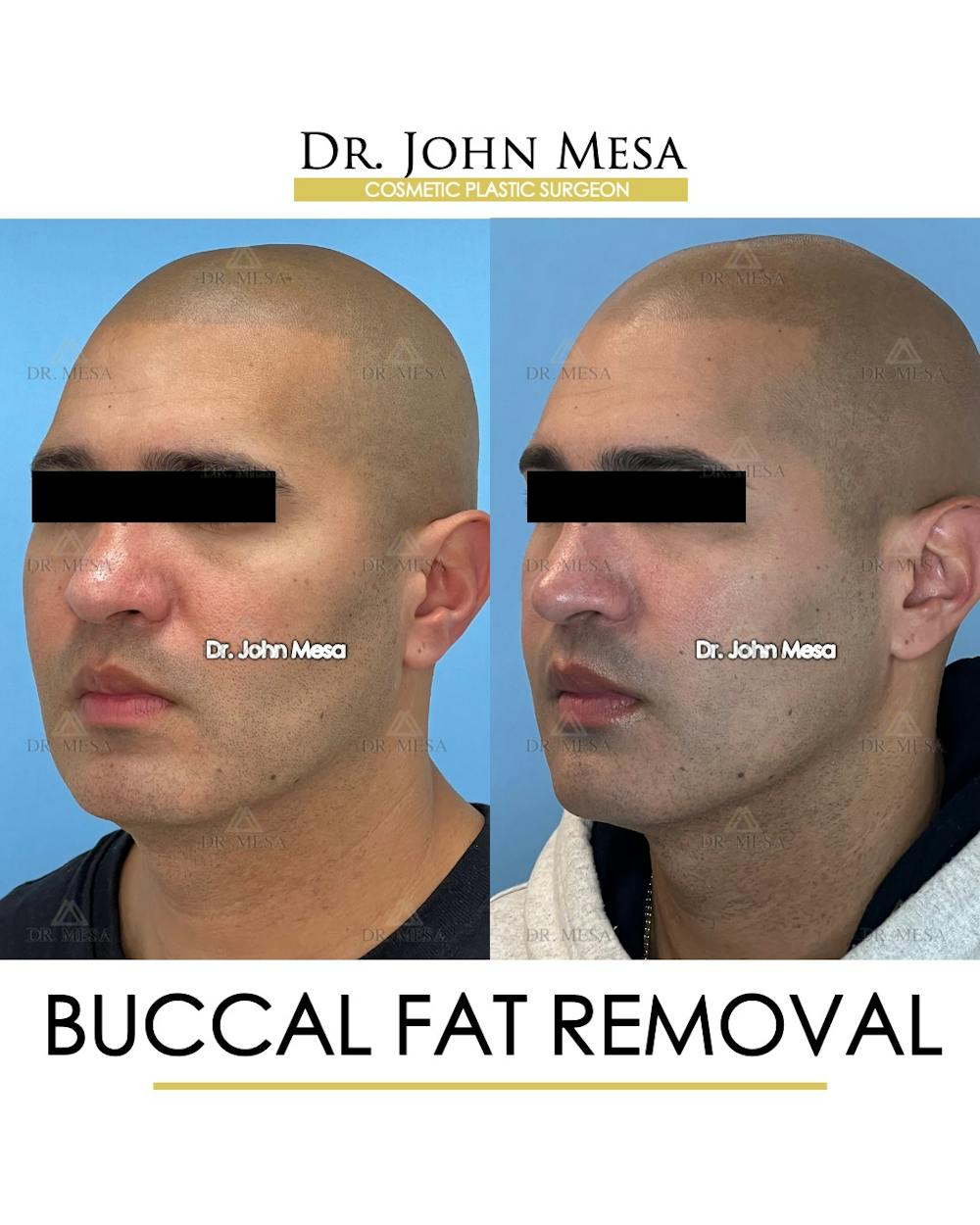 Buccal Fat Pad Removal for Men Before & After Gallery - Patient 148733547 - Image 4