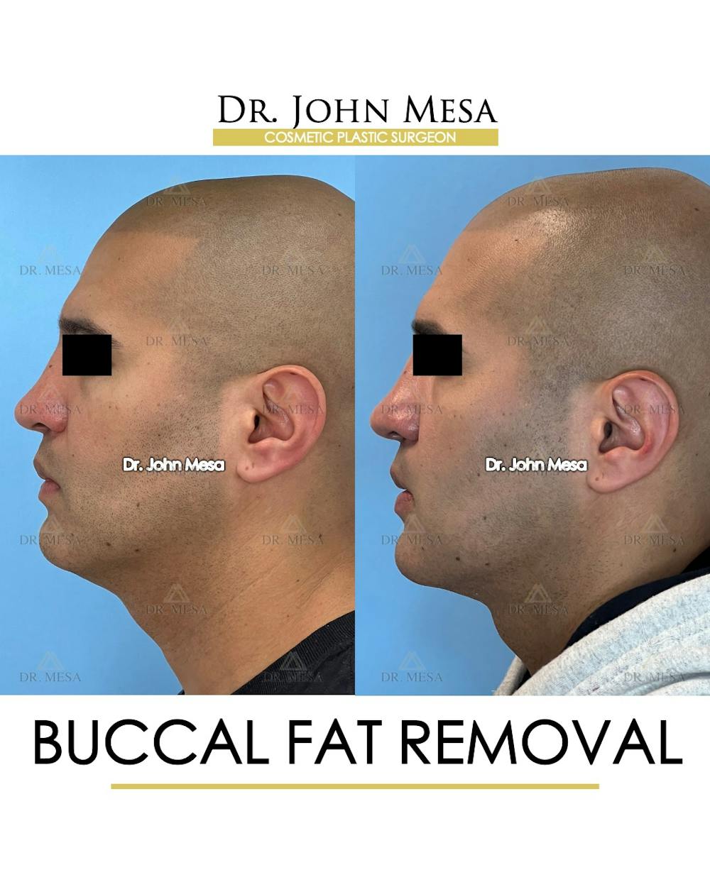 Buccal Fat Pad Removal for Men Before & After Gallery - Patient 148733547 - Image 5
