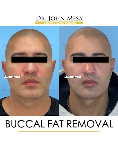Buccal Fat Pad Removal for Men Before & After Gallery - Patient 148733547 - Image 1