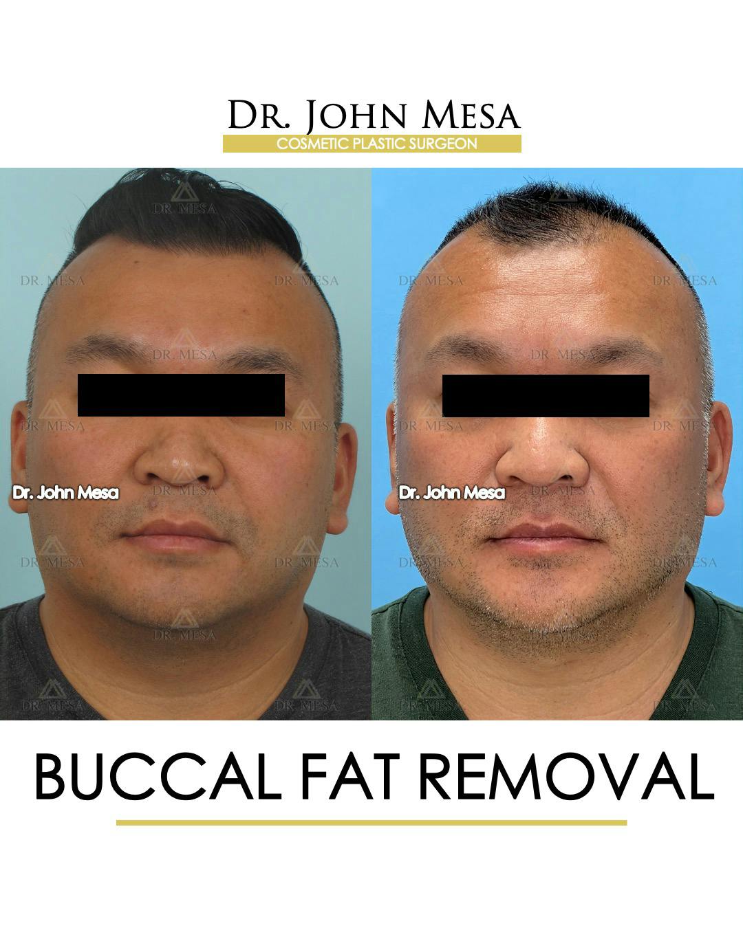 Buccal Fat Pad Removal for Men Before & After Photos Dr. Mesa