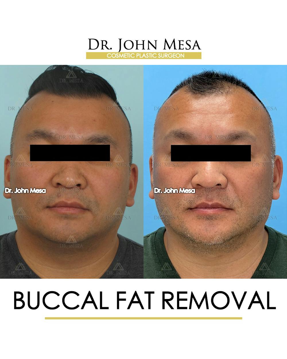 Buccal Fat Pad Removal for Men Before & After Gallery - Patient 148733546 - Image 1