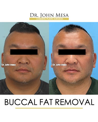 Buccal Fat Pad Removal for Men Before & After Gallery - Patient 148733546 - Image 1
