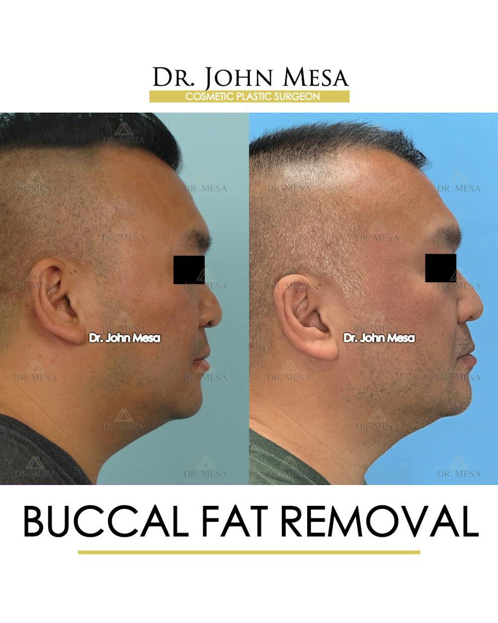 Buccal Fat Pad Removal for Men Before & After Gallery - Patient 148733546 - Image 3