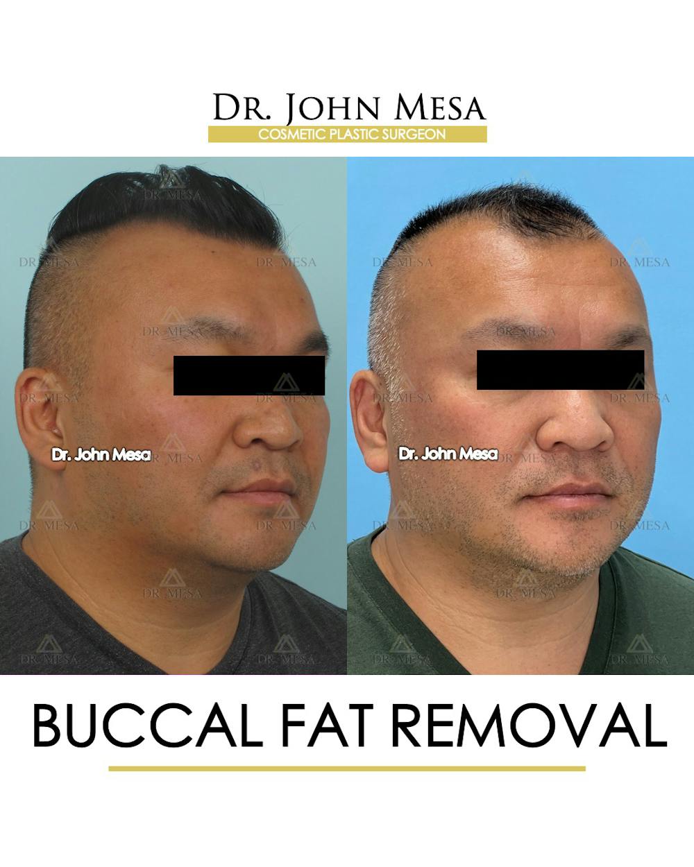 Buccal Fat Pad Removal for Men Before & After Gallery - Patient 148733546 - Image 2