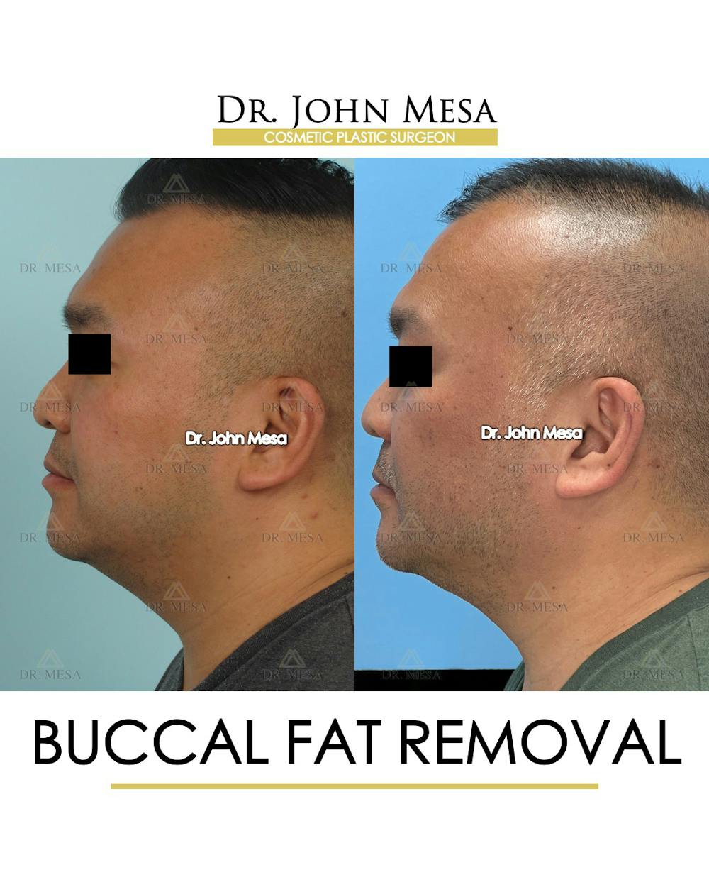 Buccal Fat Pad Removal for Men Before & After Gallery - Patient 148733546 - Image 5
