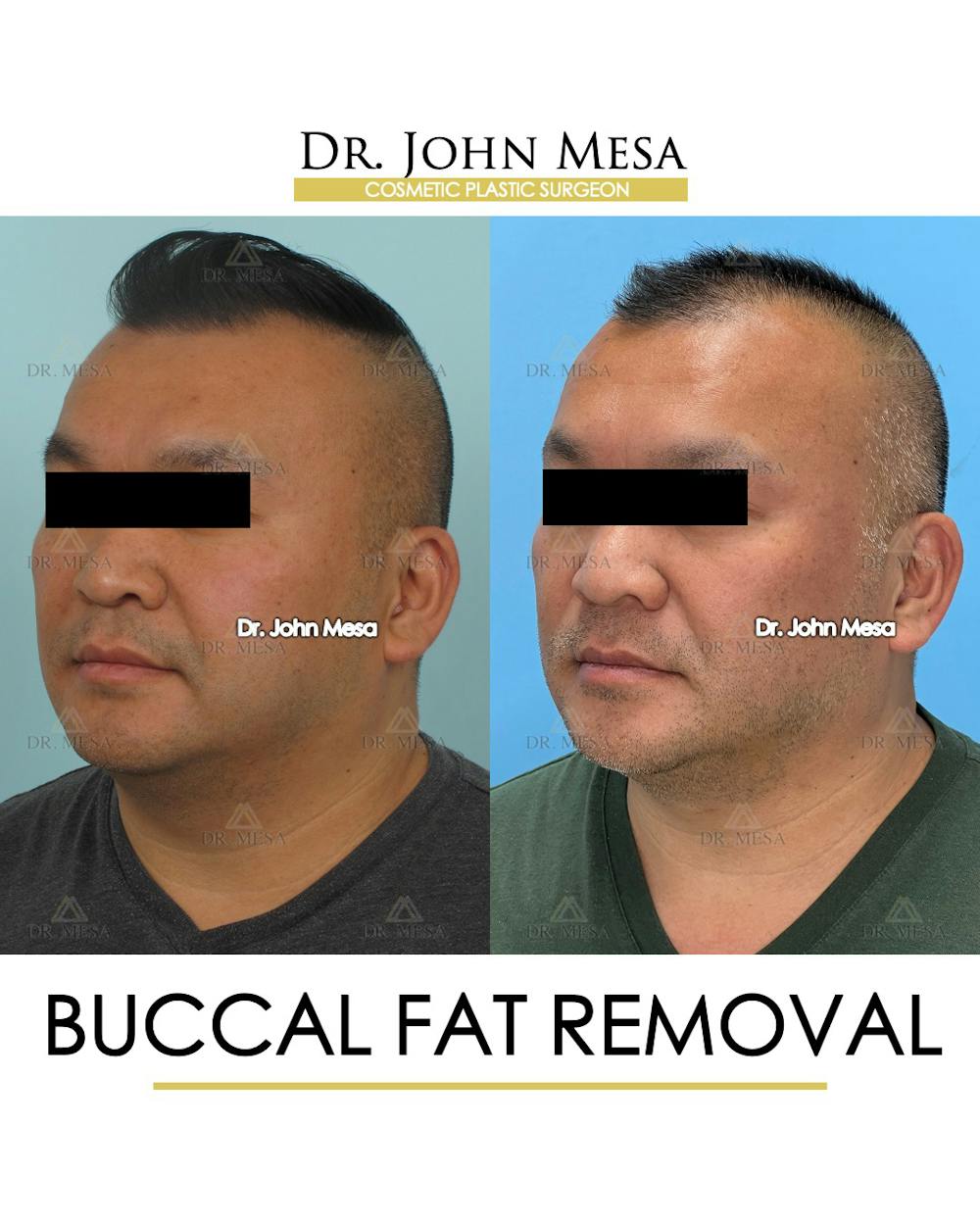 Buccal Fat Pad Removal for Men Before & After Gallery - Patient 148733546 - Image 4