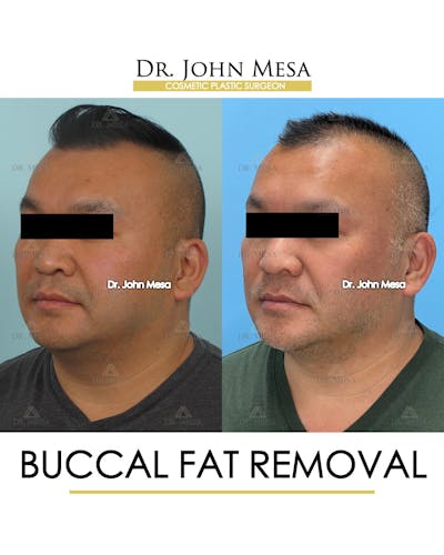 Buccal Fat Pad Removal for Men Before & After Gallery - Patient 148733546 - Image 4