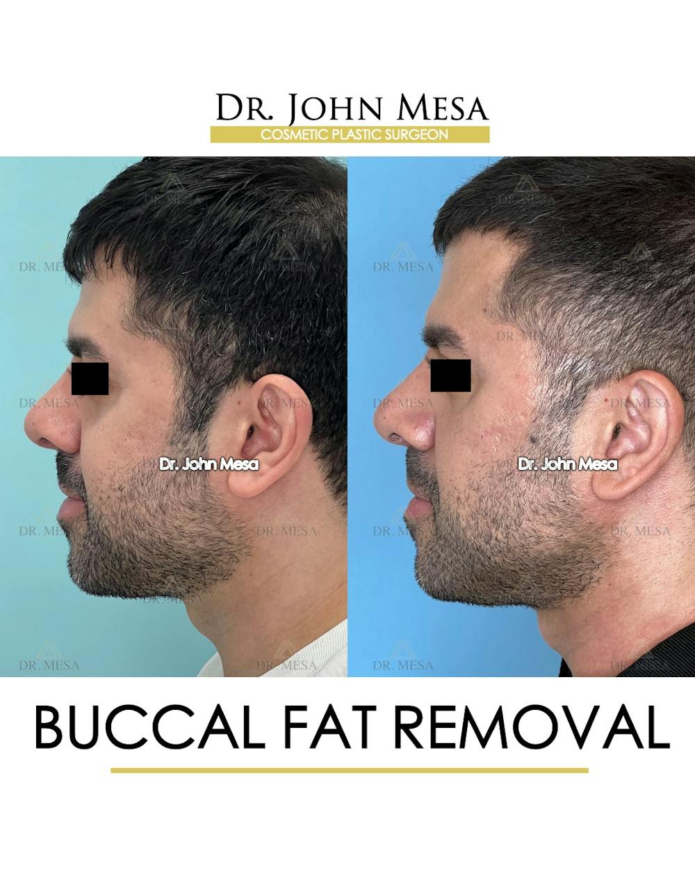 Buccal Fat Pad Removal for Men Before & After Gallery - Patient 148733545 - Image 5