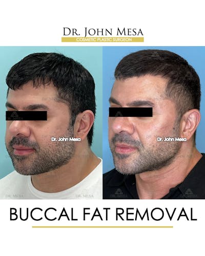 Buccal Fat Pad Removal for Men Before & After Gallery - Patient 148733545 - Image 4