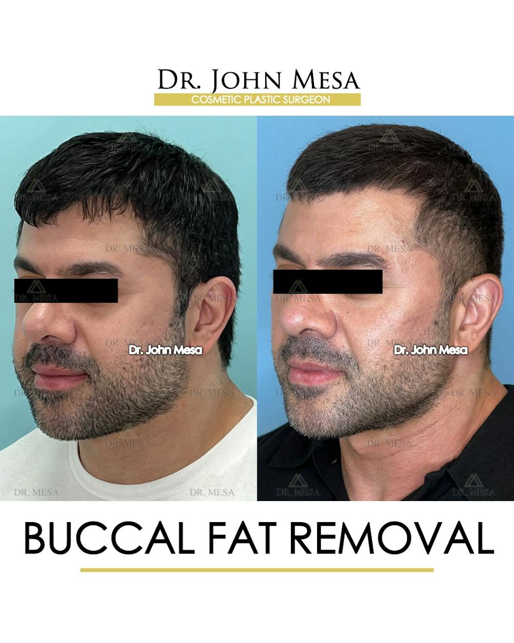 Buccal Fat Pad Removal for Men Before & After Gallery - Patient 148733545 - Image 4