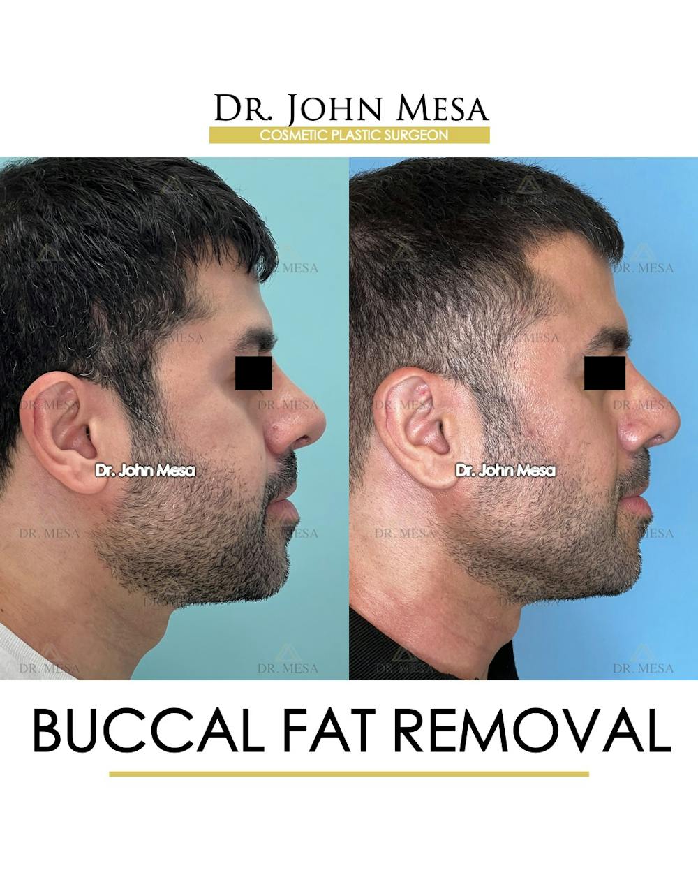 Buccal Fat Pad Removal for Men Before & After Gallery - Patient 148733545 - Image 3