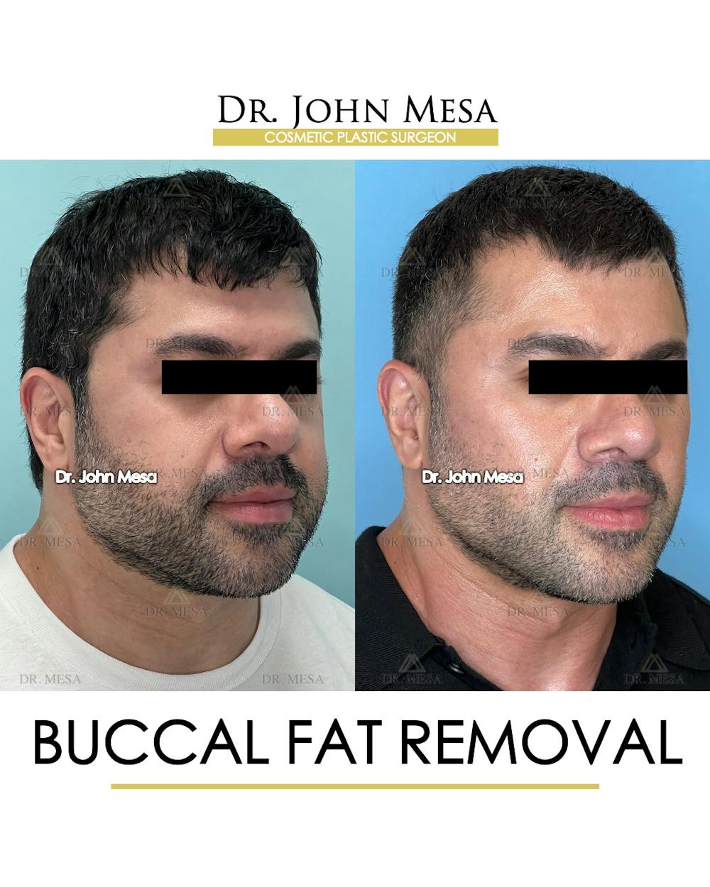 Buccal Fat Pad Removal for Men Before & After Gallery - Patient 148733545 - Image 2