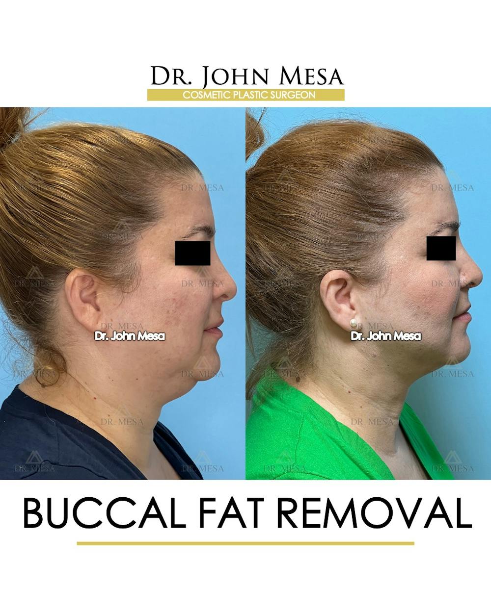 Buccal Fat Pad Removal Before & After Gallery - Patient 148733479 - Image 3