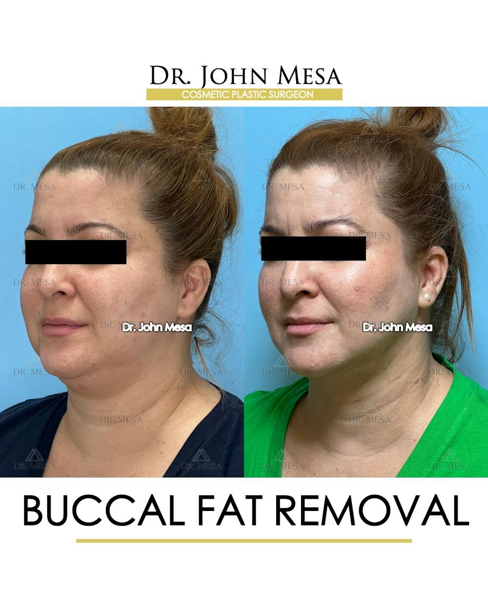 Buccal Fat Pad Removal Before & After Gallery - Patient 148733479 - Image 4