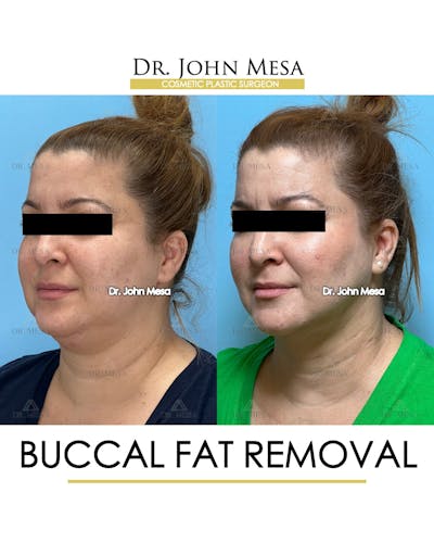 Buccal Fat Pad Removal Before & After Gallery - Patient 148733479 - Image 4