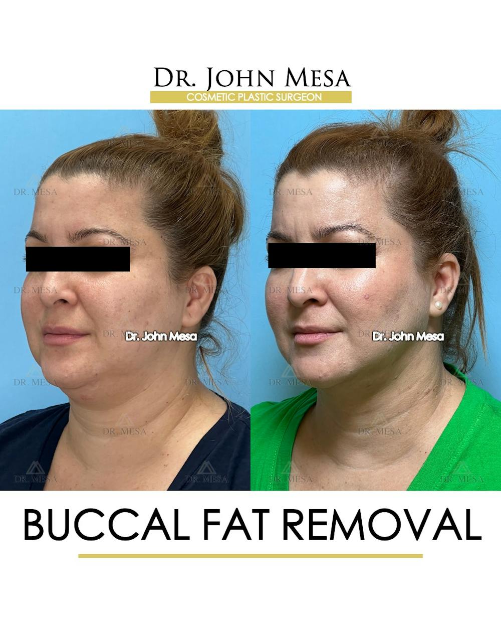 Buccal Fat Pad Removal Before & After Gallery - Patient 148733479 - Image 4