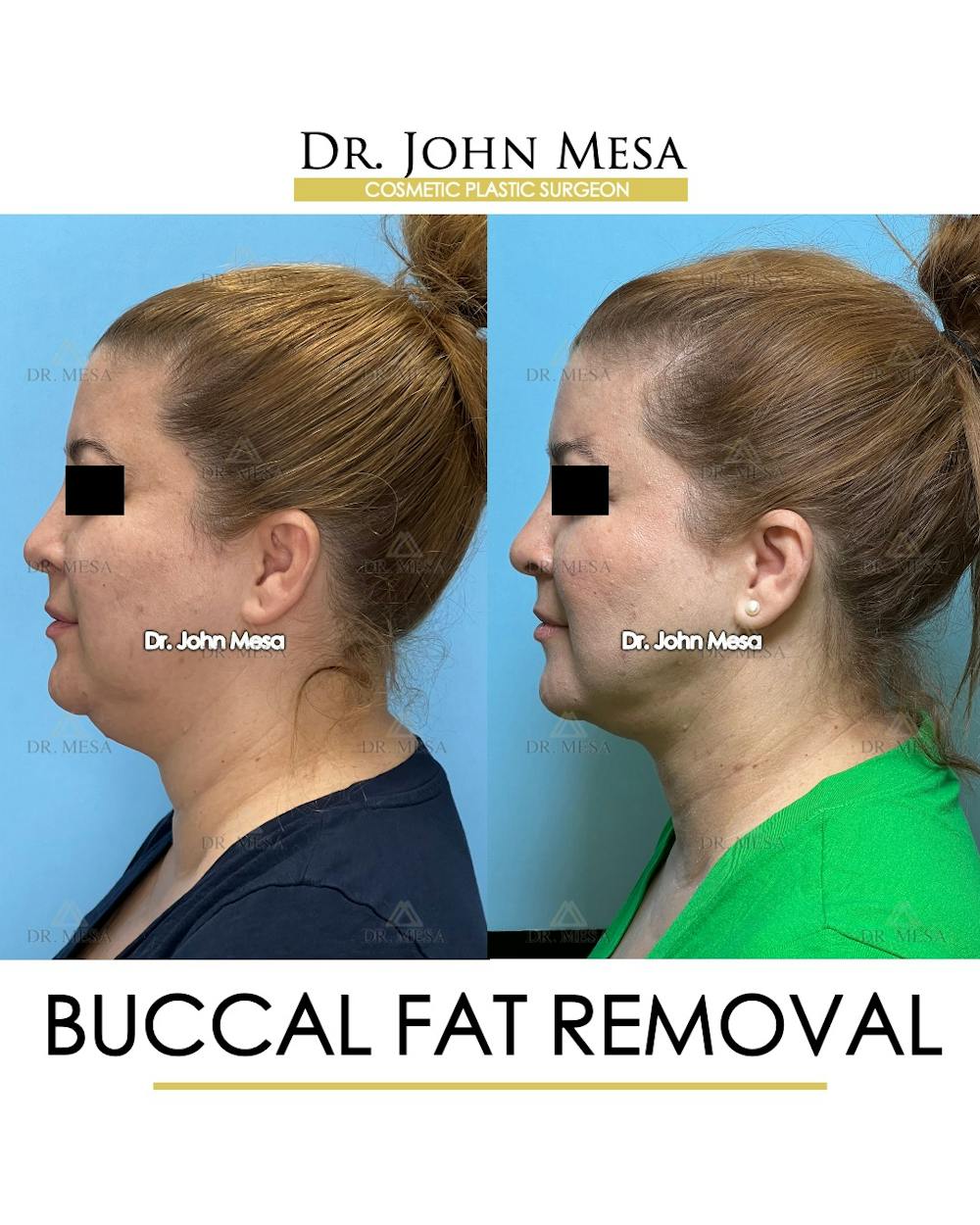 Buccal Fat Pad Removal Before & After Gallery - Patient 148733479 - Image 5