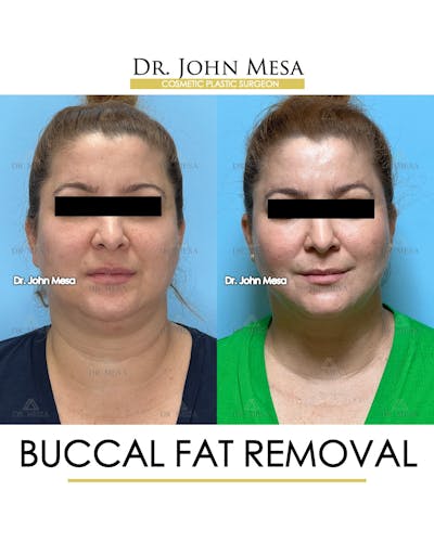 Buccal Fat Pad Removal Before & After Gallery - Patient 148733479 - Image 1