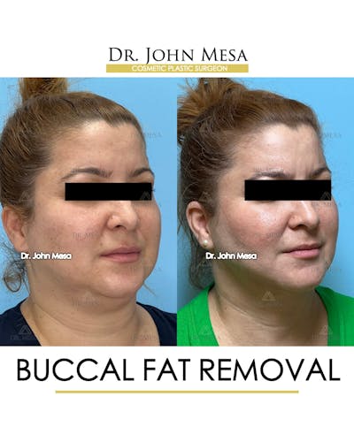 Buccal Fat Pad Removal Before & After Gallery - Patient 148733479 - Image 2