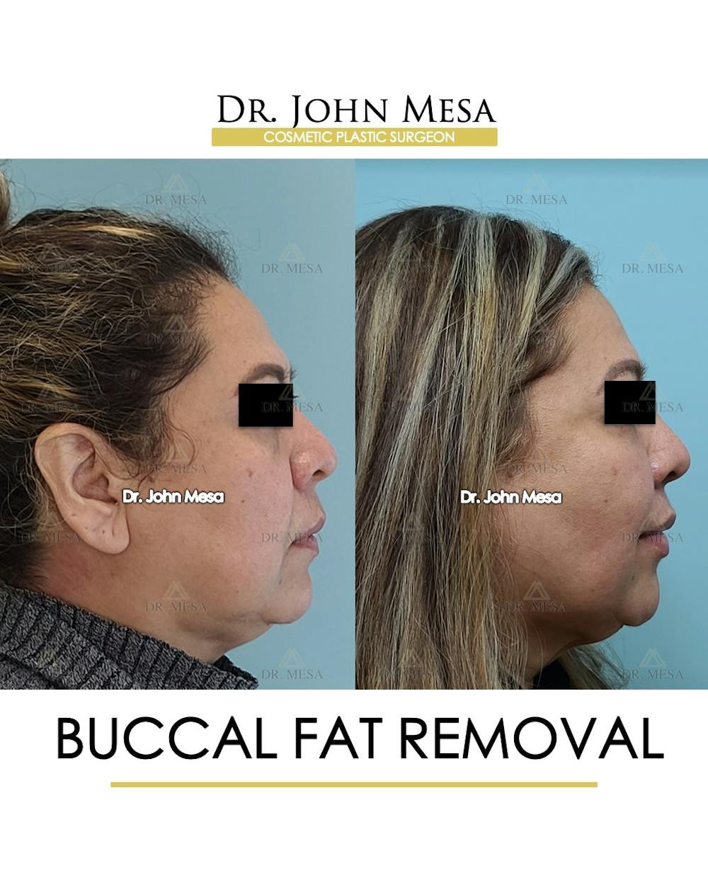 Buccal Fat Pad Removal Before & After Gallery - Patient 148733478 - Image 3