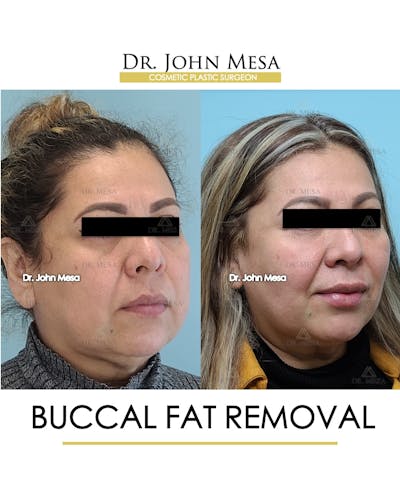 Buccal Fat Pad Removal Before & After Gallery - Patient 148733478 - Image 2