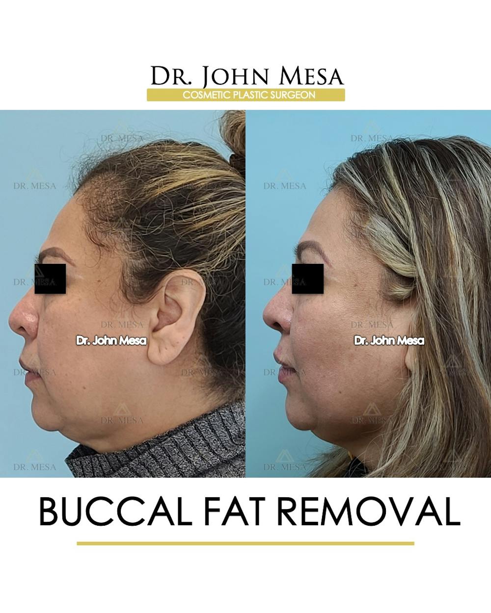 Buccal Fat Pad Removal Before & After Gallery - Patient 148733478 - Image 5