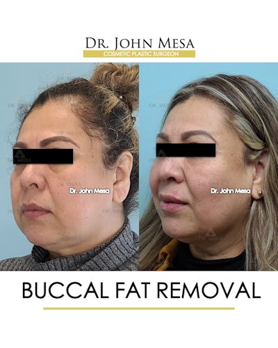 Buccal Fat Pad Removal Before & After Gallery - Patient 148733478 - Image 4
