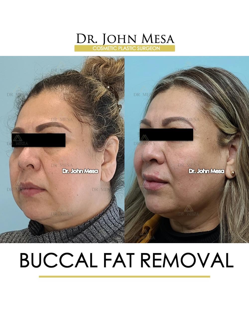 Buccal Fat Pad Removal Before & After Gallery - Patient 148733478 - Image 4